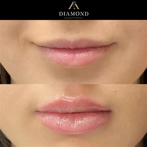 Lip Fillers in New York, NY 